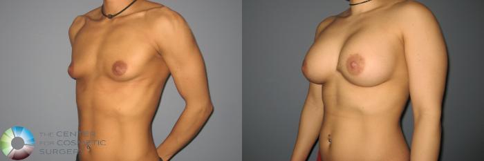 Before & After Breast Augmentation Case 870 View #1 View in Golden, CO