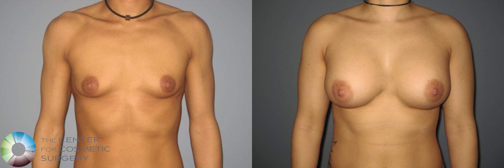 Before & After Breast Augmentation Case 870 View #2 in Denver and Colorado Springs, CO