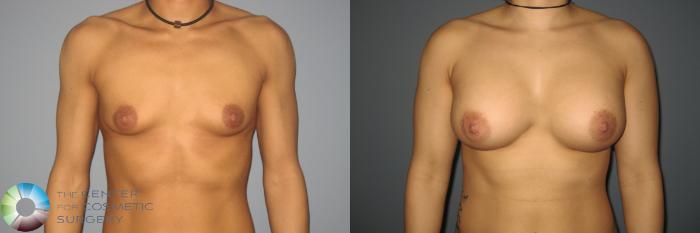 Before & After Breast Augmentation Case 870 View #2 View in Golden, CO