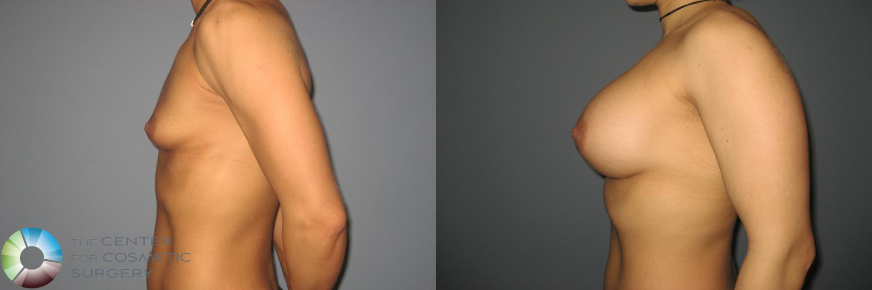 Before & After Breast Augmentation Case 870 View #3 in Denver and Colorado Springs, CO