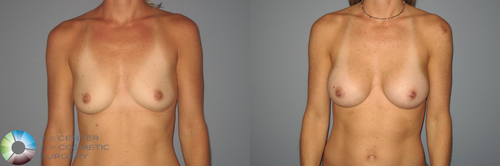 Before & After Breast Augmentation Case 871 View #1 in Denver and Colorado Springs, CO