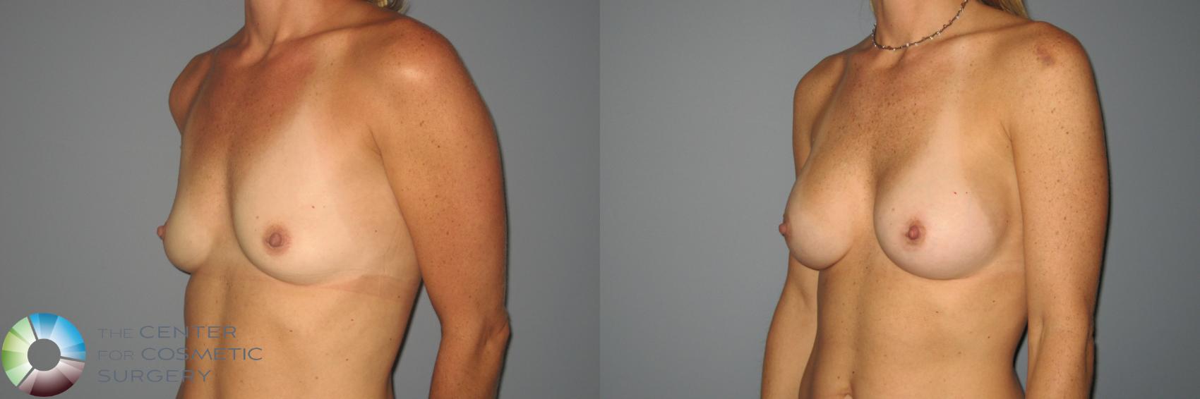 Before & After Breast Augmentation Case 871 View #2 in Denver and Colorado Springs, CO