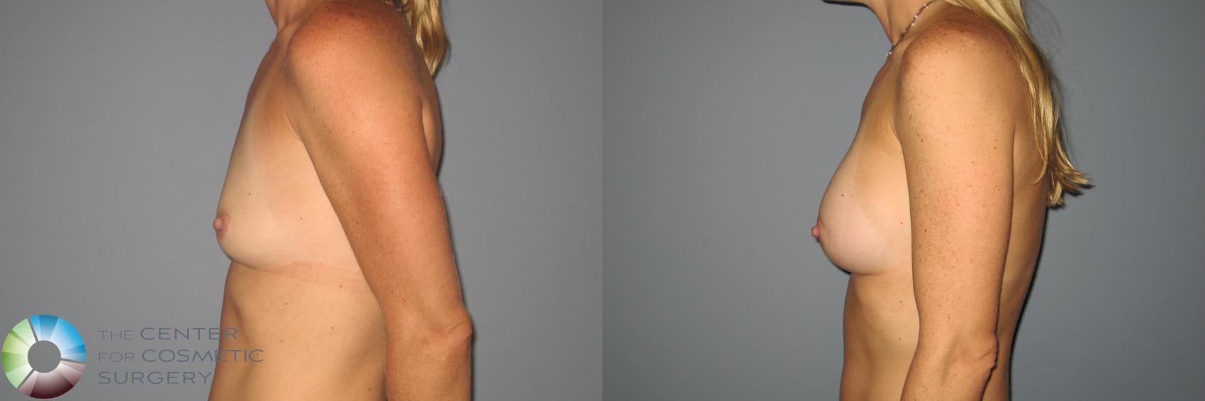 Before & After Breast Augmentation Case 871 View #3 in Denver and Colorado Springs, CO