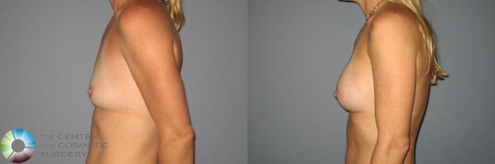 Before & After Breast Augmentation Case 871 View #3 View in Golden, CO
