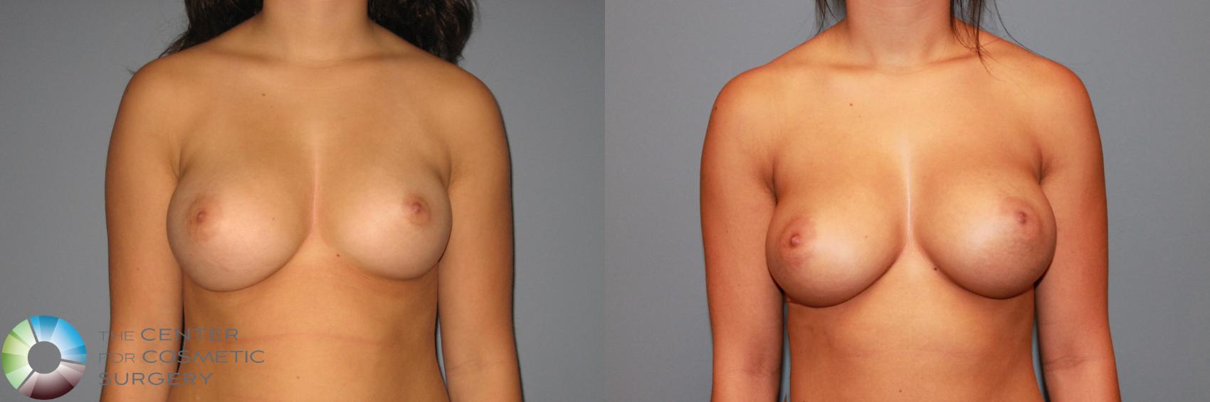 Before & After Breast Augmentation Case 872 View #1 in Denver and Colorado Springs, CO