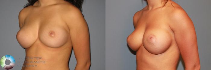 Before & After Breast Augmentation Case 872 View #2 View in Golden, CO