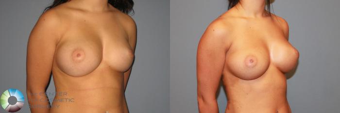 Before & After Breast Augmentation Case 872 View #3 View in Golden, CO