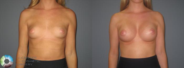Before & After Breast Augmentation Case 873 View #1 in Denver and Colorado Springs, CO
