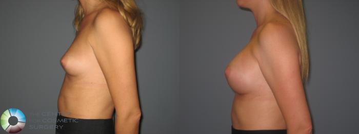 Before & After Breast Augmentation Case 873 View #2 in Denver and Colorado Springs, CO