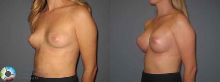 Before & After Breast Augmentation Case 873 View #3 in Denver and Colorado Springs, CO