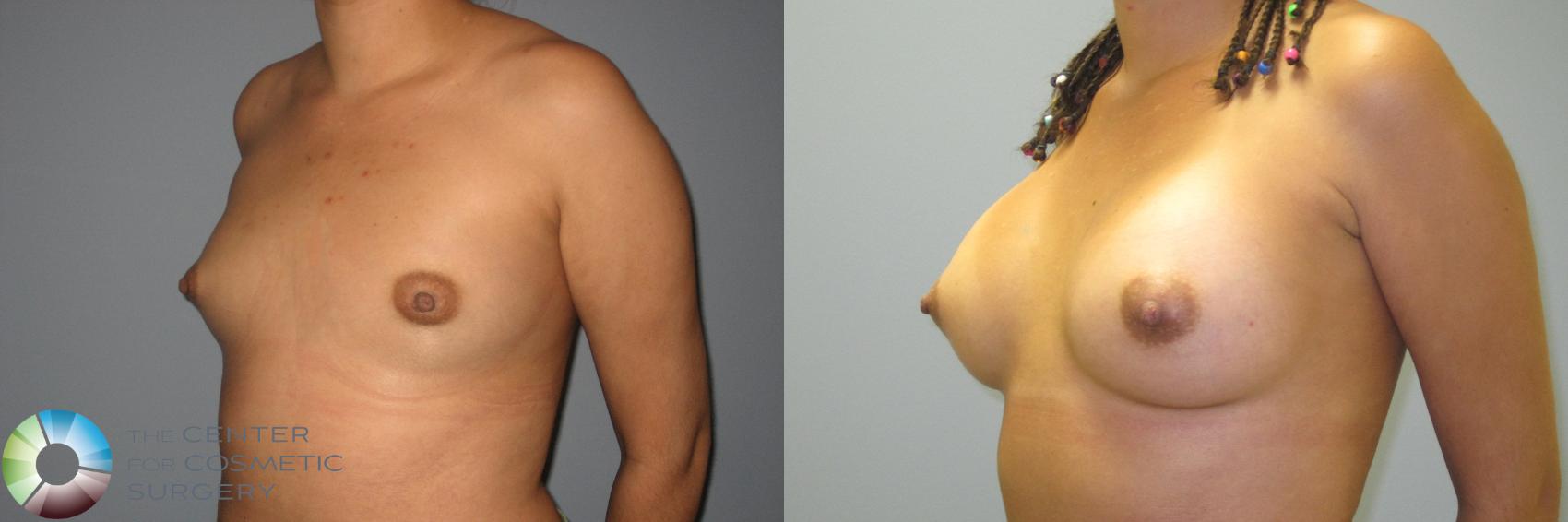 Before & After Breast Augmentation Case 875 View #1 in Denver and Colorado Springs, CO