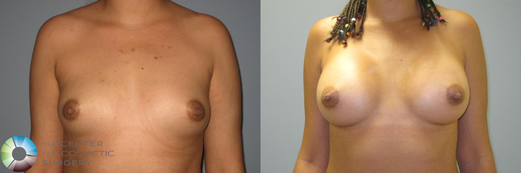 Before & After Breast Augmentation Case 875 View #2 View in Golden, CO