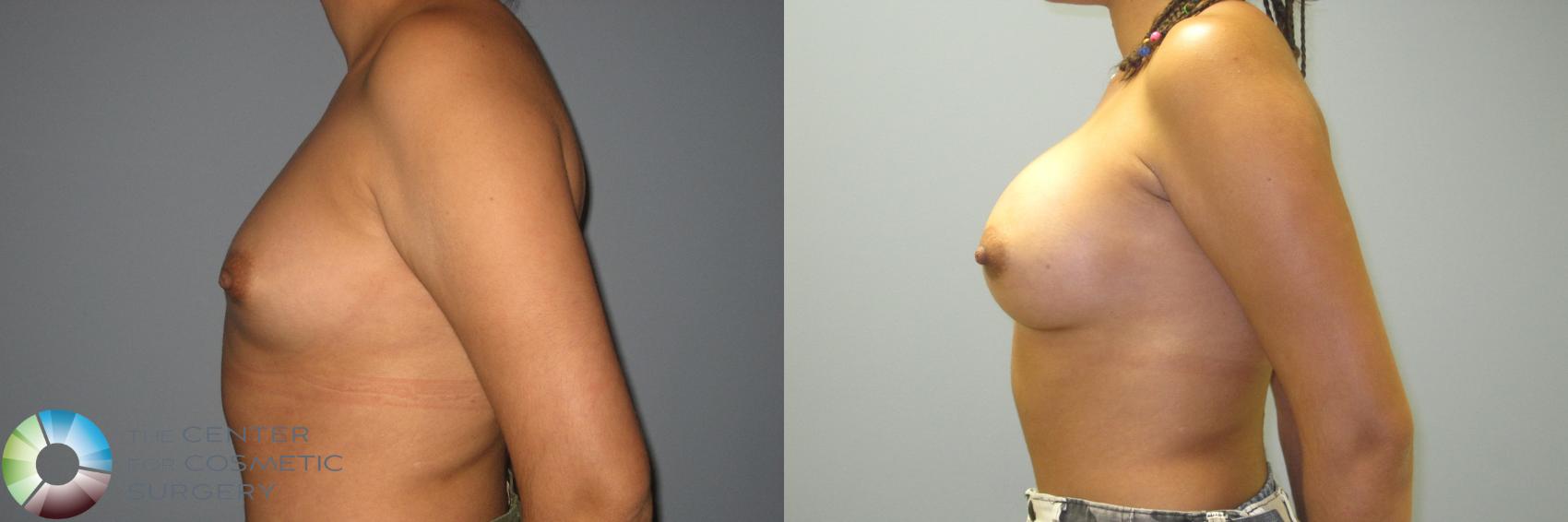 Before & After Breast Augmentation Case 875 View #3 View in Golden, CO