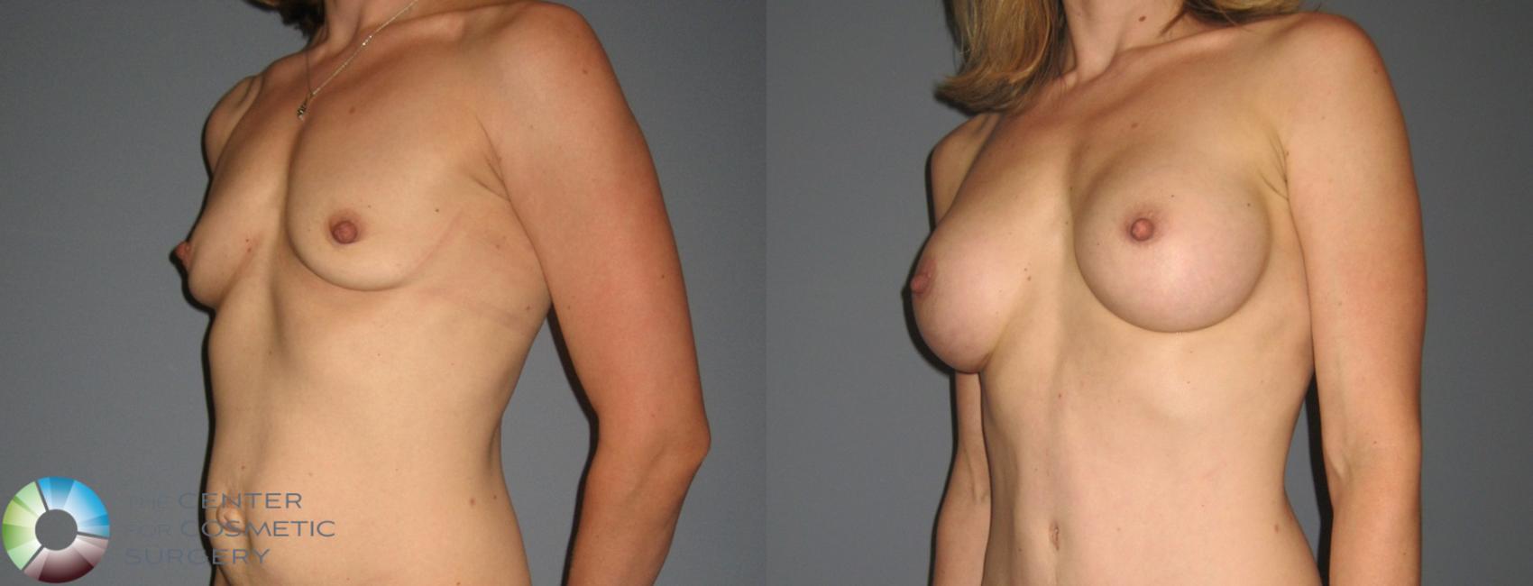 Before & After Breast Augmentation Case 878 View #1 in Denver and Colorado Springs, CO