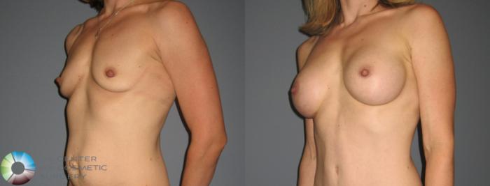 Before & After Breast Augmentation Case 878 View #1 View in Golden, CO