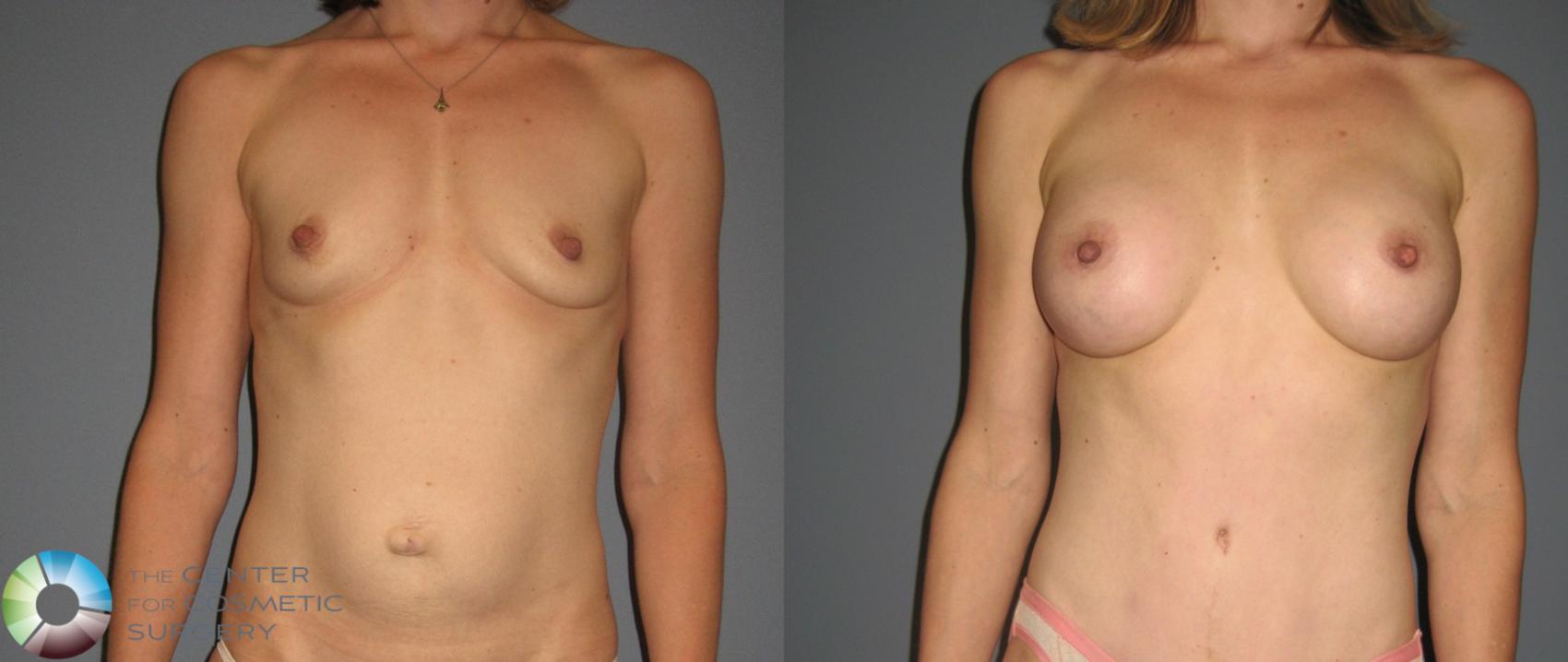 Before & After Breast Augmentation Case 878 View #2 View in Golden, CO