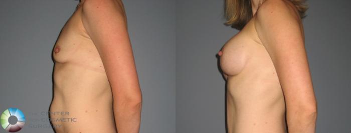 Before & After Breast Augmentation Case 878 View #3 View in Golden, CO