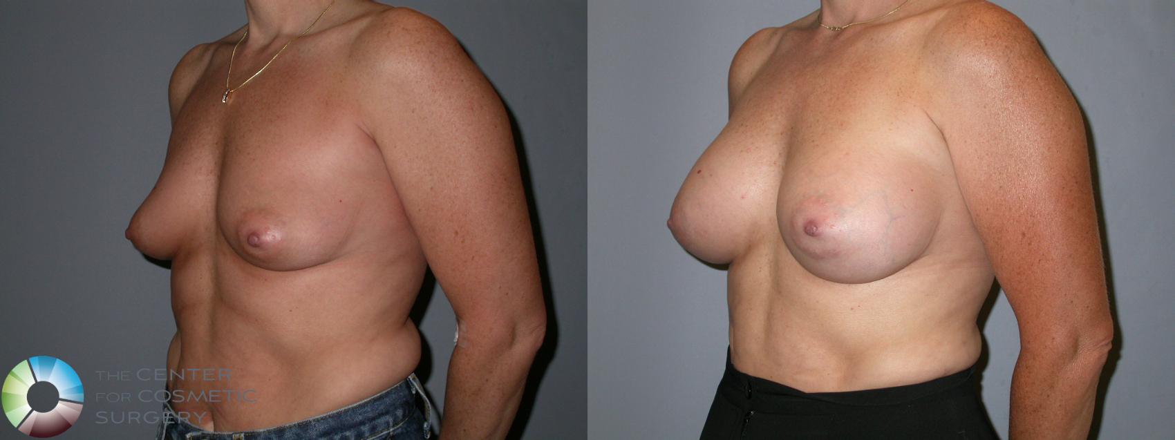 Before & After Breast Augmentation Case 88 View #1 in Denver and Colorado Springs, CO