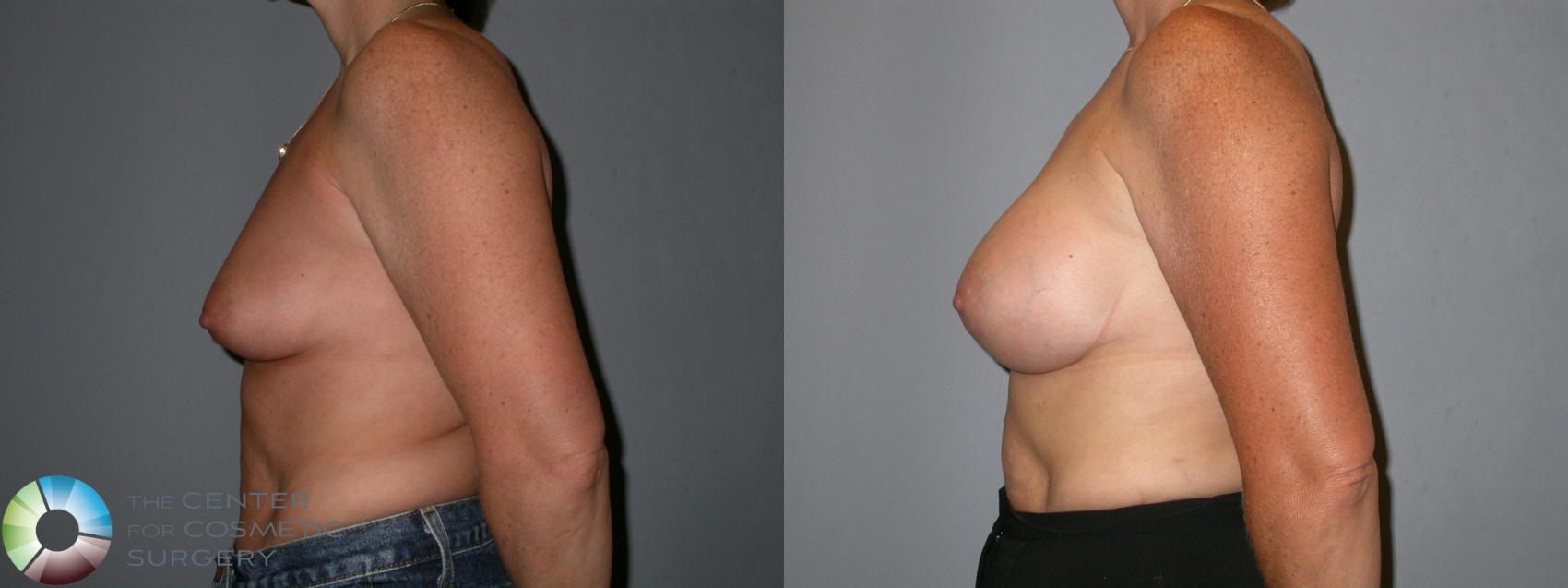 Before & After Breast Augmentation Case 88 View #2 View in Golden, CO