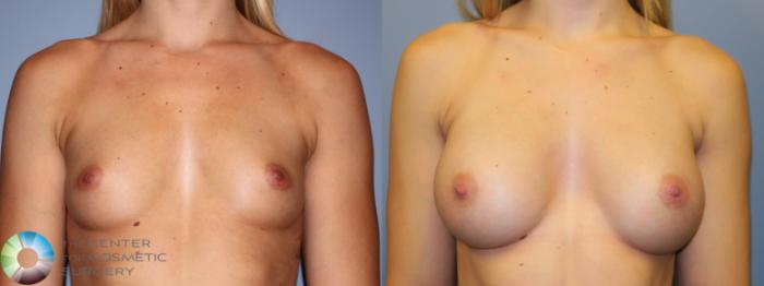 Before & After Breast Augmentation Case 880 Front in Denver and Colorado Springs, CO
