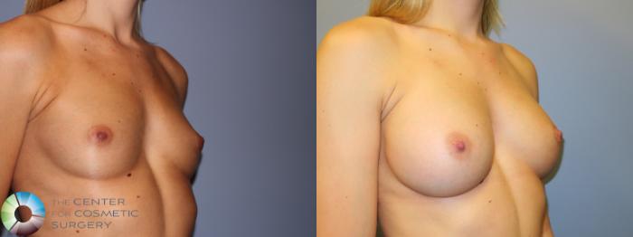 Before & After Breast Augmentation Case 880 Right Oblique in Denver and Colorado Springs, CO