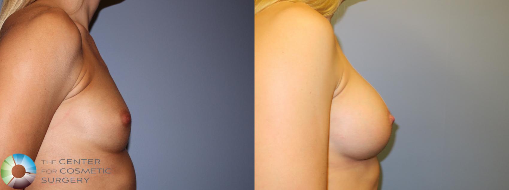 Before & After Breast Augmentation Case 880 Right Side in Denver and Colorado Springs, CO
