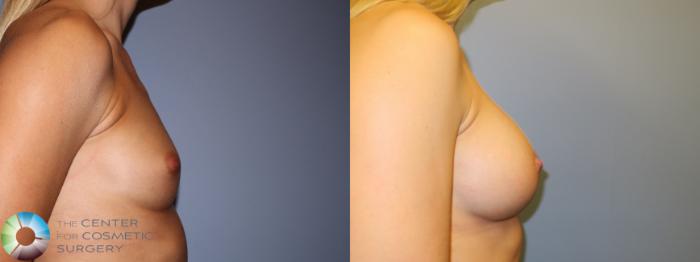 Before & After Breast Augmentation Case 880 Right Side in Denver and Colorado Springs, CO