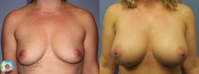 Before & After Breast Augmentation Case 881 View #1 View in Golden, CO