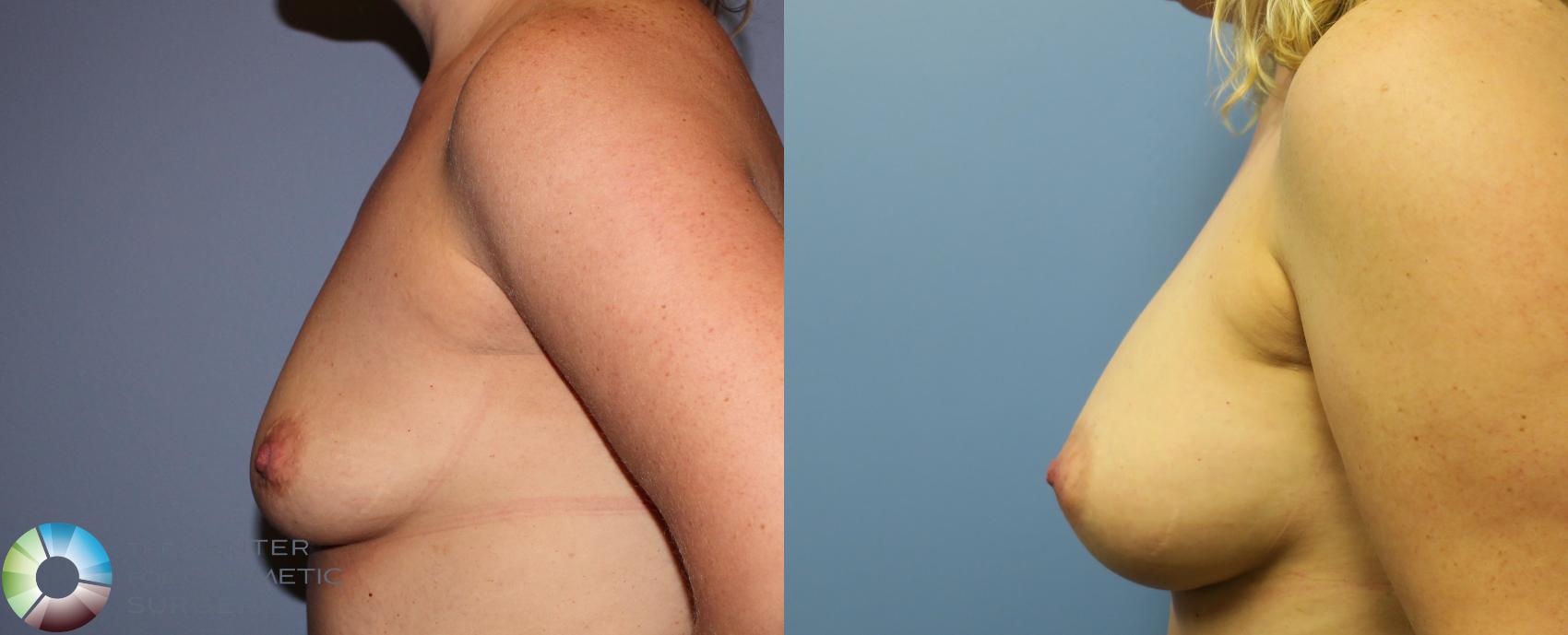 Before & After Breast Augmentation Case 881 View #2 in Denver and Colorado Springs, CO
