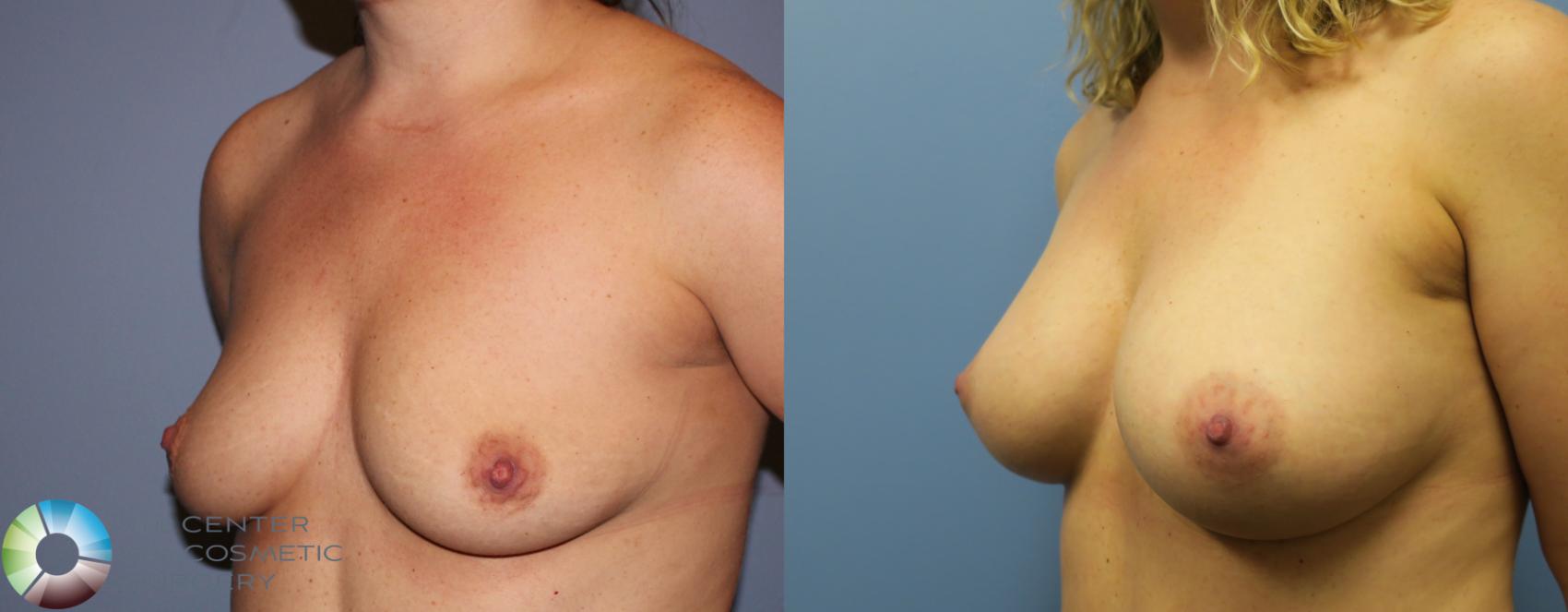 Before & After Breast Augmentation Case 881 View #3 in Denver and Colorado Springs, CO