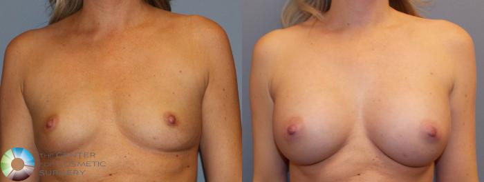 Before & After Breast Augmentation Case 884 View #1 View in Golden, CO