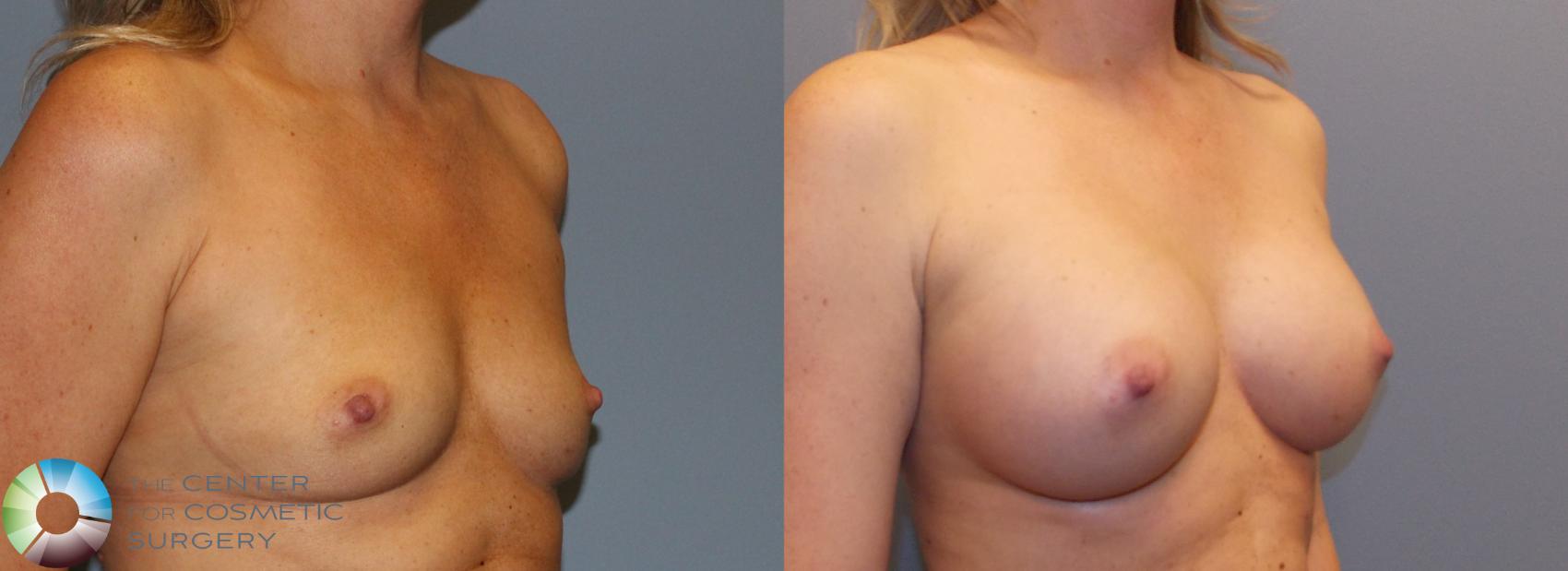 Before & After Breast Augmentation Case 884 View #2 View in Golden, CO
