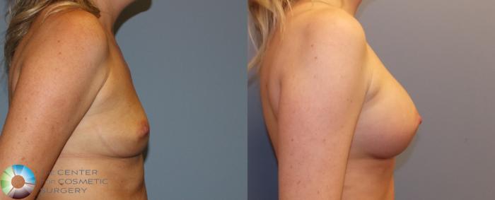 Before & After Breast Augmentation Case 884 View #3 View in Golden, CO