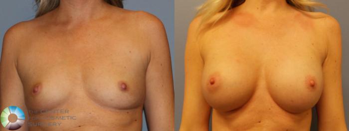 Before & After Breast Augmentation Case 884 View #4 View in Golden, CO