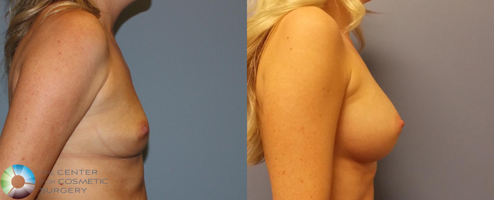 Before & After Breast Augmentation Case 884 View #5 View in Golden, CO