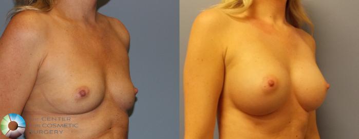 Before & After Breast Augmentation Case 884 View #6 View in Golden, CO