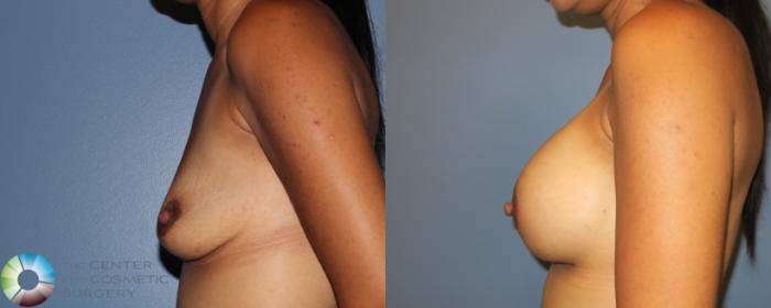 Before & After Breast Augmentation Case 885 View #1 View in Golden, CO