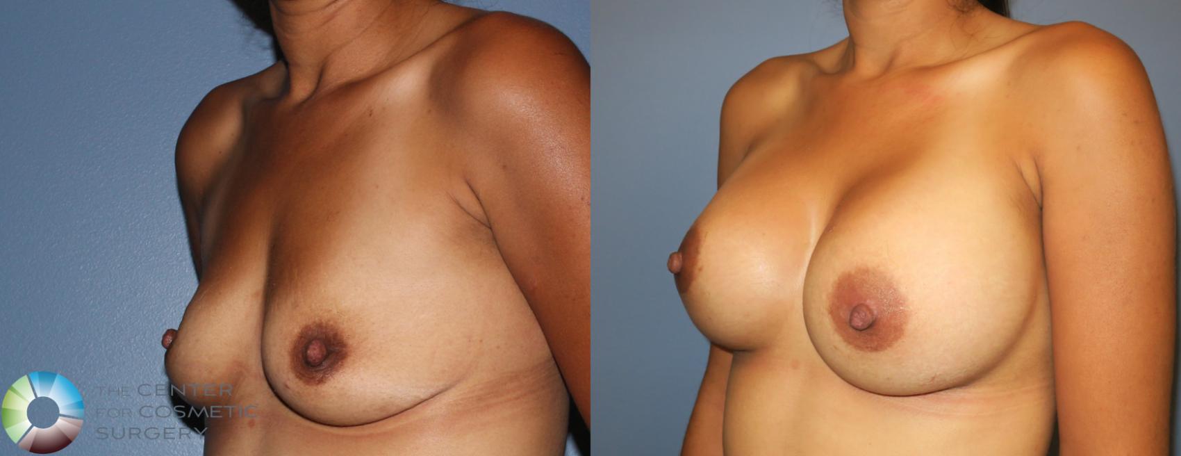 Before & After Breast Augmentation Case 885 View #2 in Denver and Colorado Springs, CO