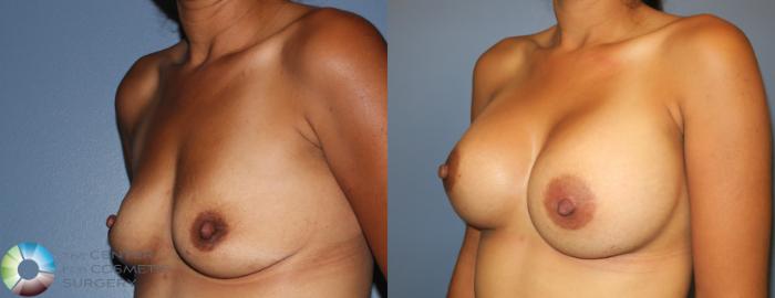 Before & After Breast Augmentation Case 885 View #2 View in Golden, CO