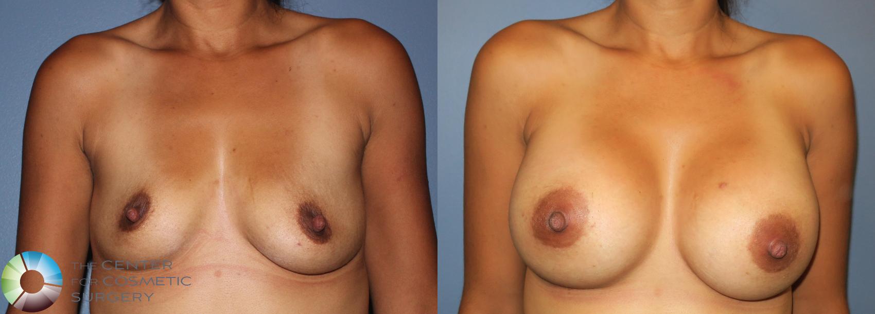 Before & After Breast Augmentation Case 885 View #3 in Denver and Colorado Springs, CO