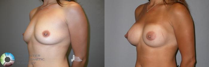 Before & After Breast Augmentation Case 89 View #1 in Denver and Colorado Springs, CO