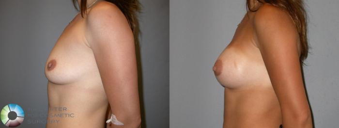 Before & After Breast Augmentation Case 89 View #2 in Denver and Colorado Springs, CO