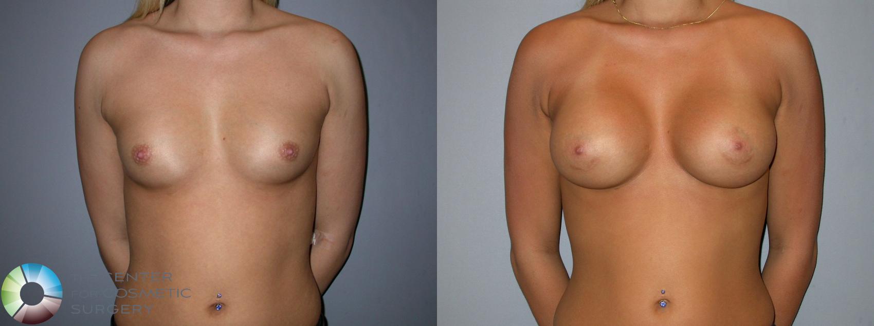 Before & After Breast Augmentation Case 90 View #1 in Denver and Colorado Springs, CO