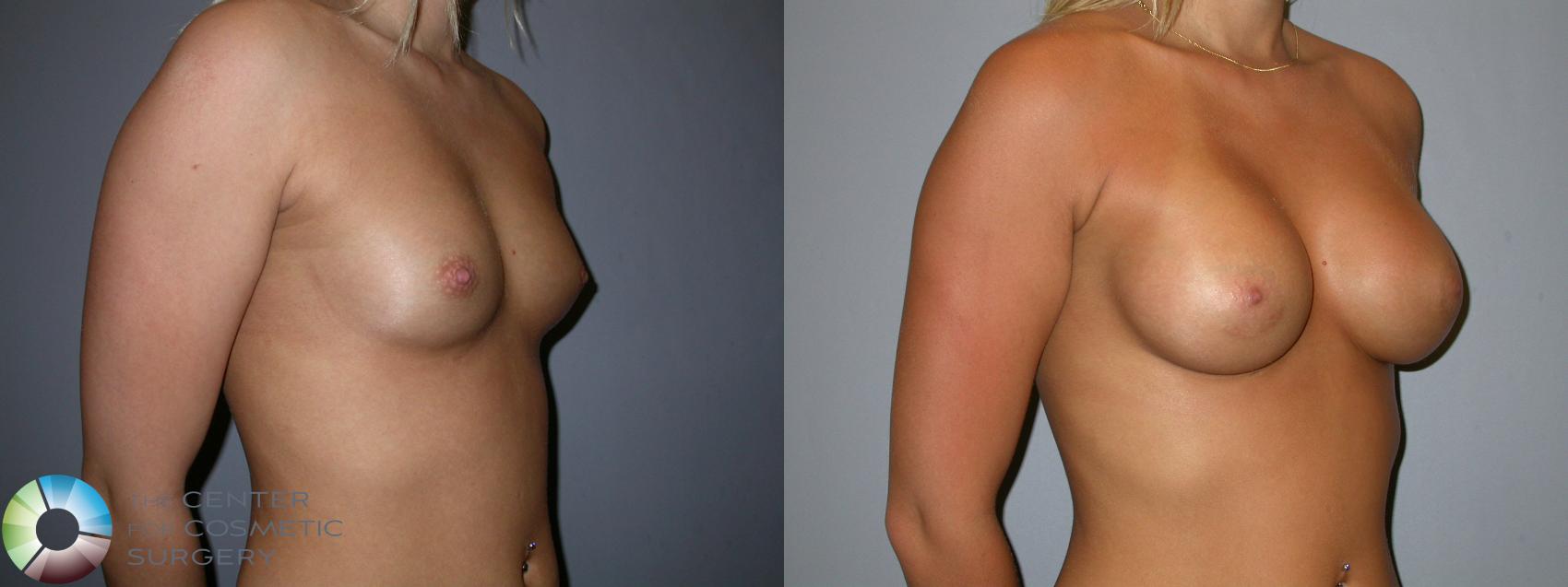 Before & After Breast Augmentation Case 90 View #2 in Denver and Colorado Springs, CO