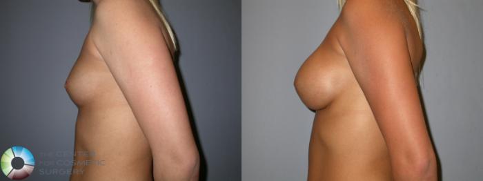 Before & After Breast Augmentation Case 90 View #3 in Denver and Colorado Springs, CO