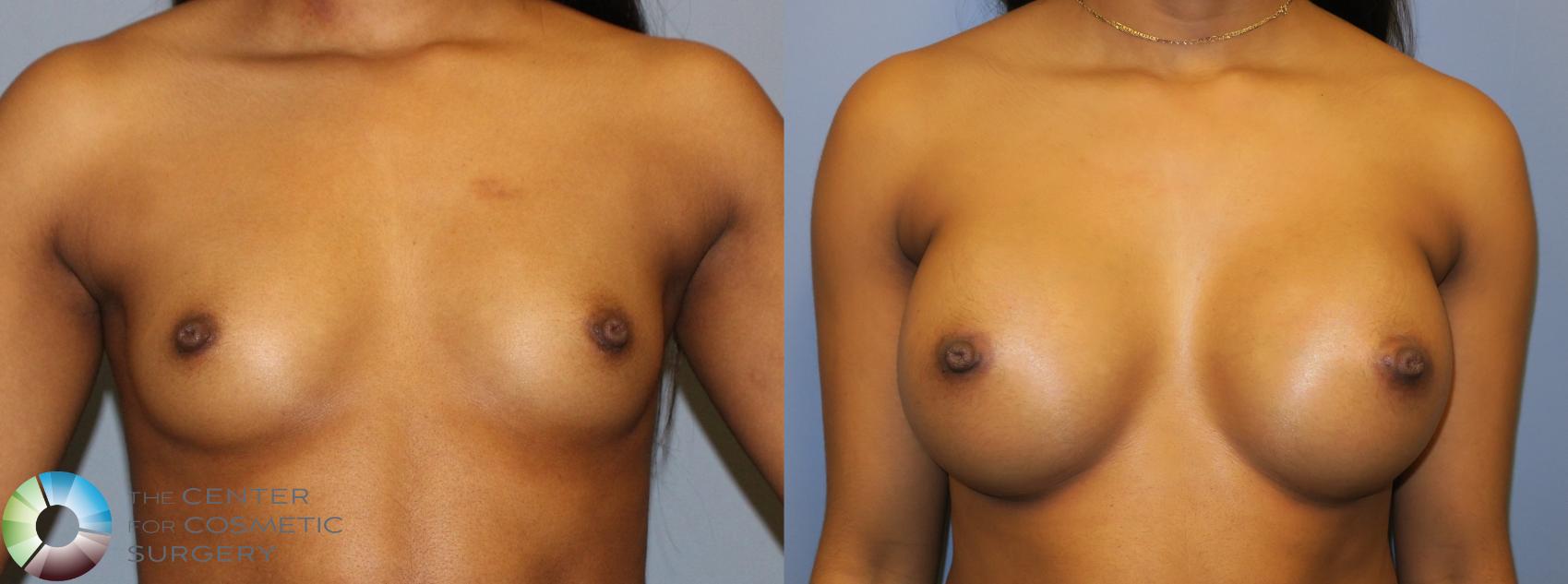 Before & After Breast Augmentation Case 901 View #1 in Denver and Colorado Springs, CO