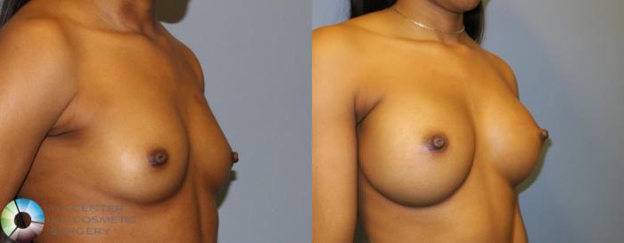 Before & After Breast Augmentation Case 901 View #2 View in Golden, CO