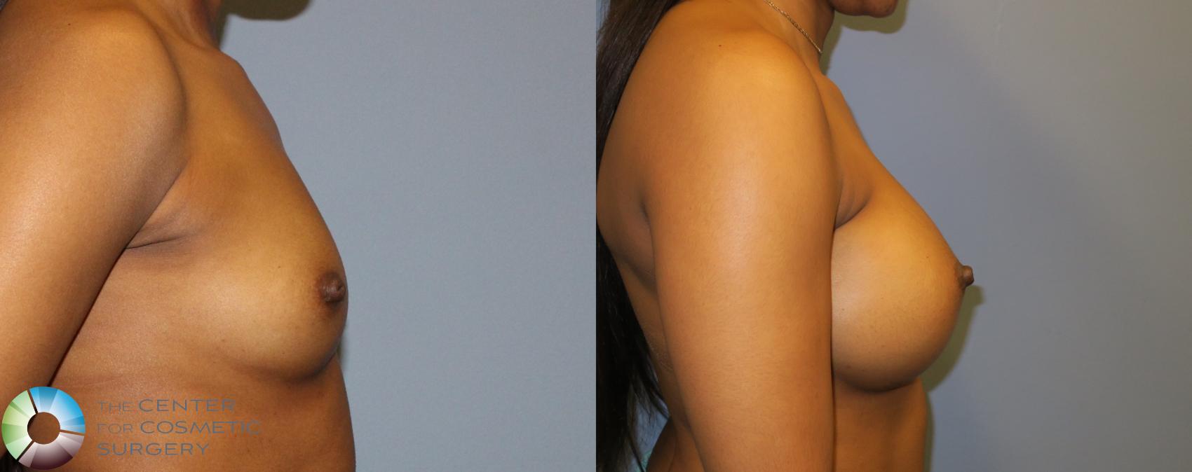 Before & After Breast Augmentation Case 901 View #3 View in Golden, CO