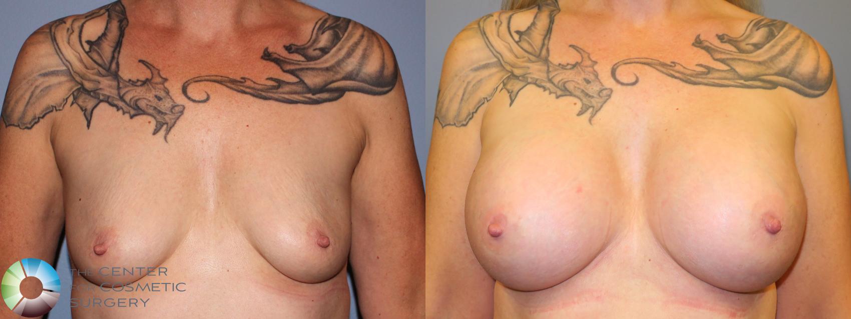 Before & After Breast Augmentation Case 905 View #1 in Denver, CO