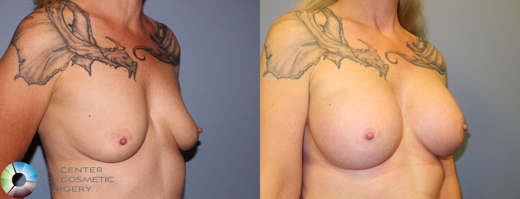 Before & After Breast Augmentation Case 905 View #2 in Denver and Colorado Springs, CO